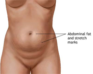 Abdominoplasty surgery