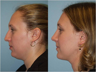 Chin liposuction surgery