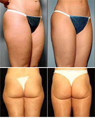 Liposuction surgery